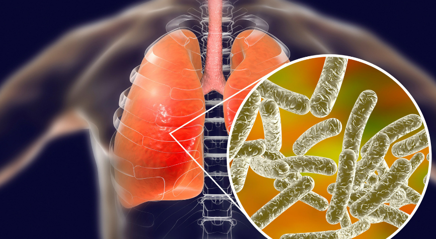 How Do People Catch Legionnaires Disease